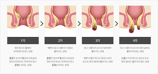 치질 단계 분류