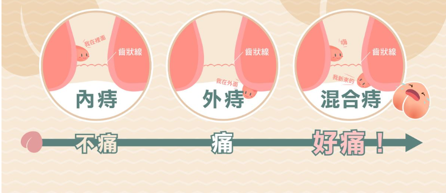 外痔