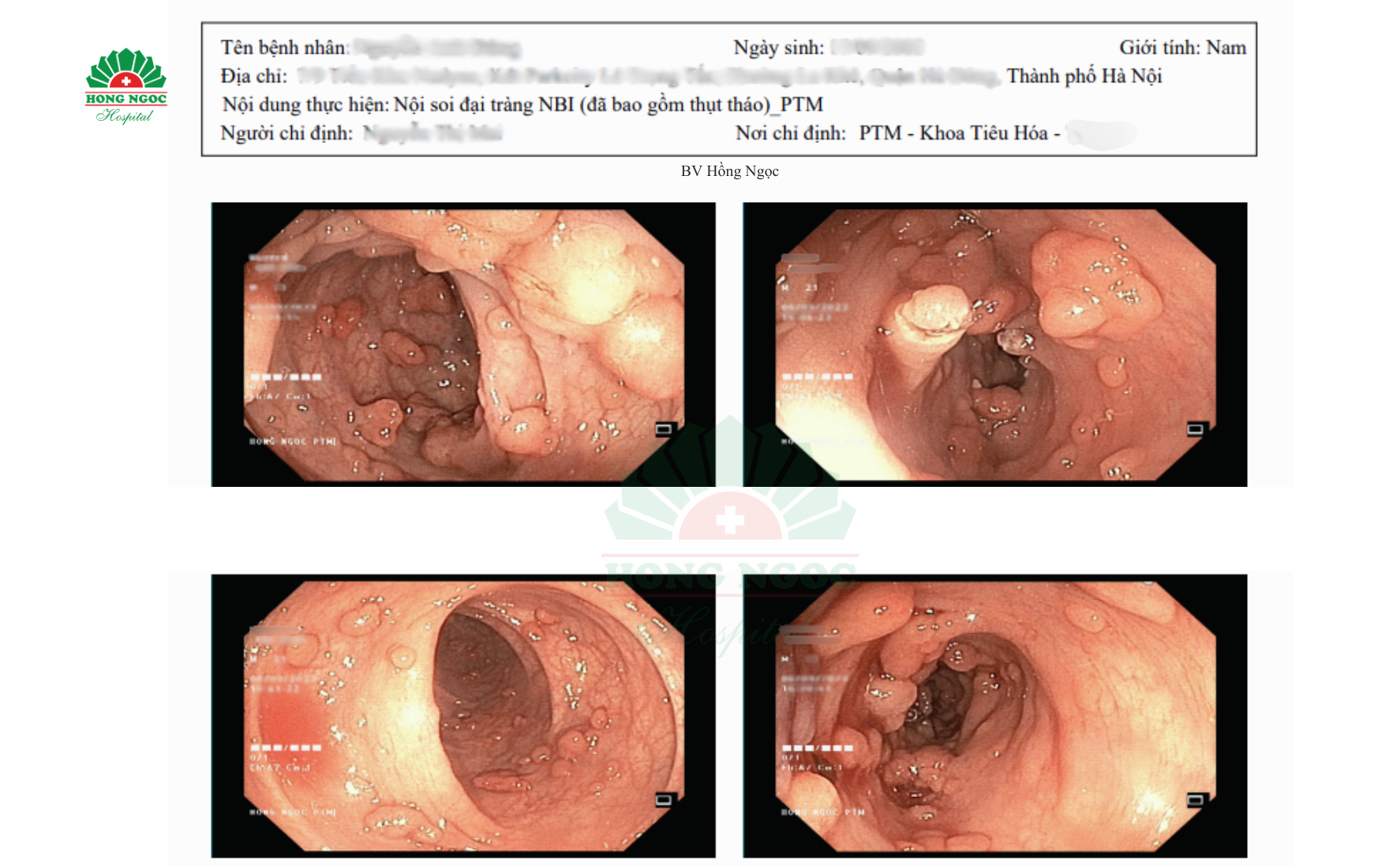 Đa Polyp   Đăng Web 1