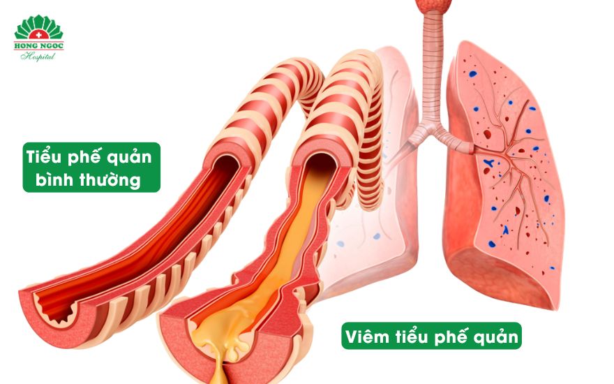 viêm tiểu phế quản ở trẻ nhỏ