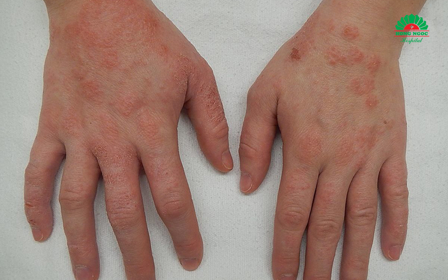 viêm da tiếp xúc