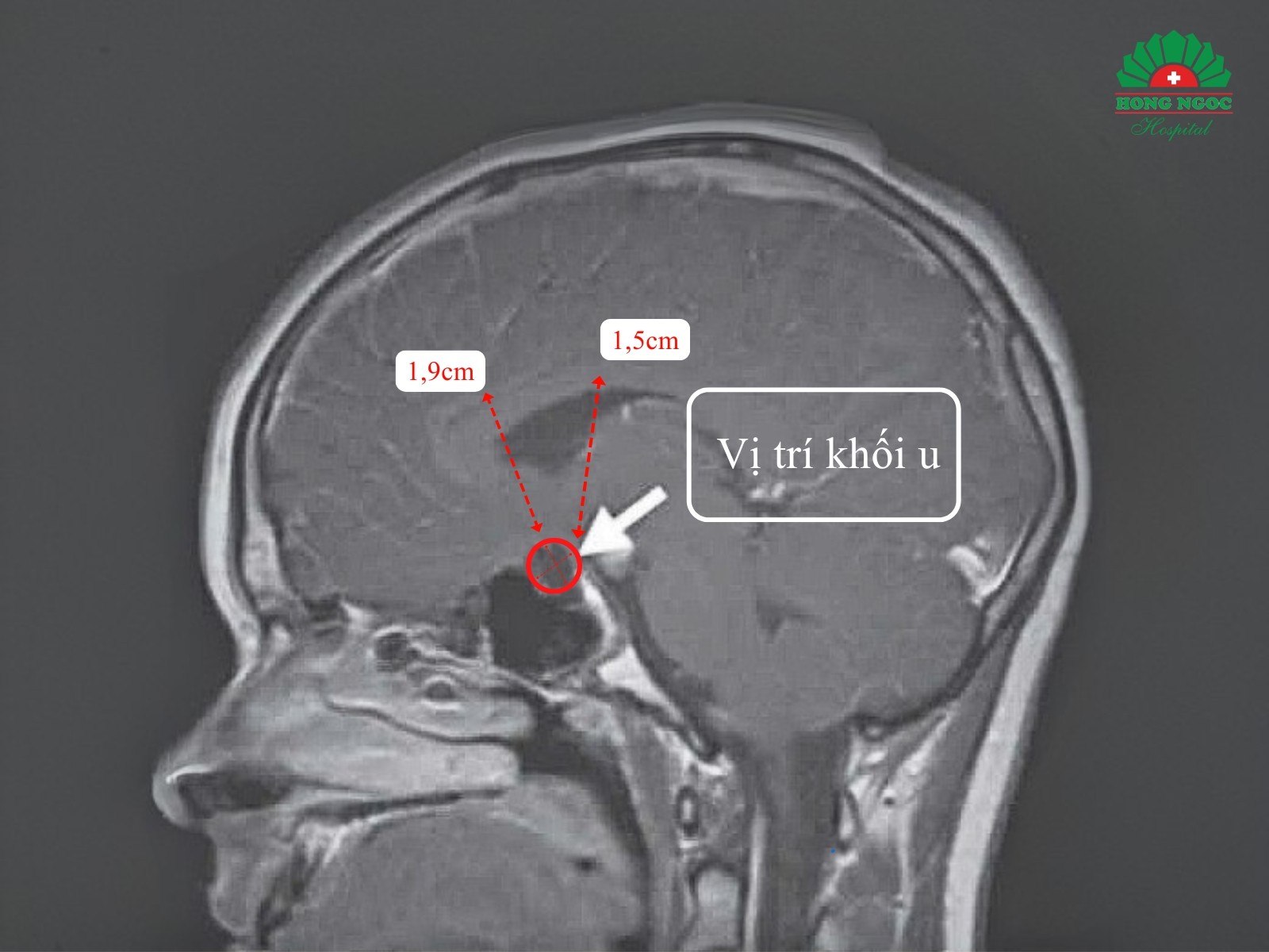 Khối u nằm sát giao thoa thị giác và gần trung tâm điều hòa nội tiết của não bộ.