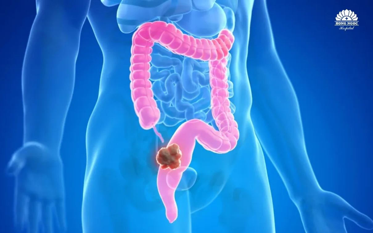 benh-ung-thu-truc-trang