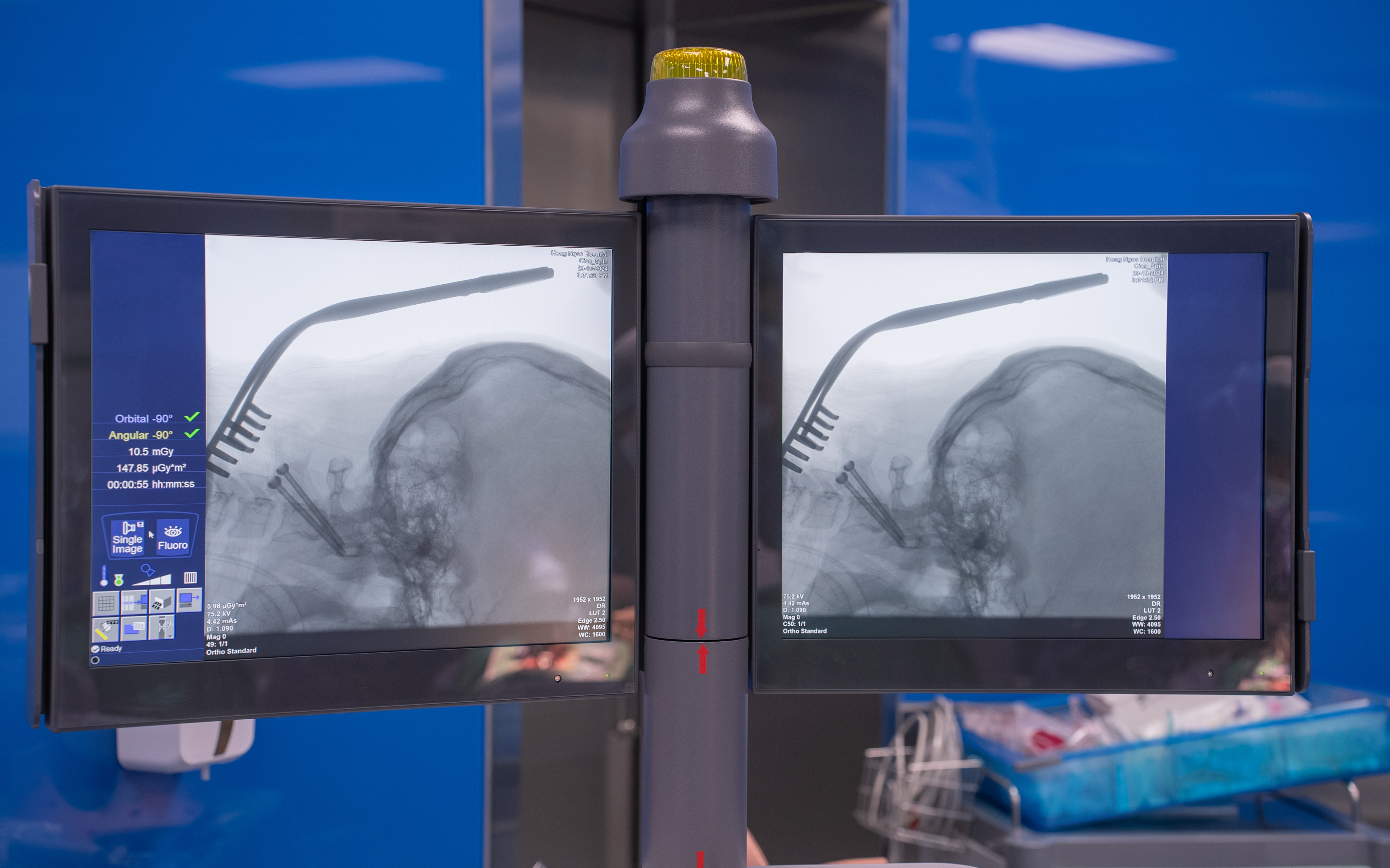 Gãy đốt sống cổ