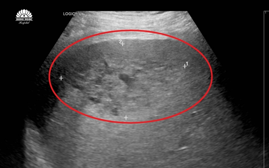 nguoi-dan-ong-nguy-kich-vi-o-ap-xe-gan-lon-chiem-gan-tron-gan-phai