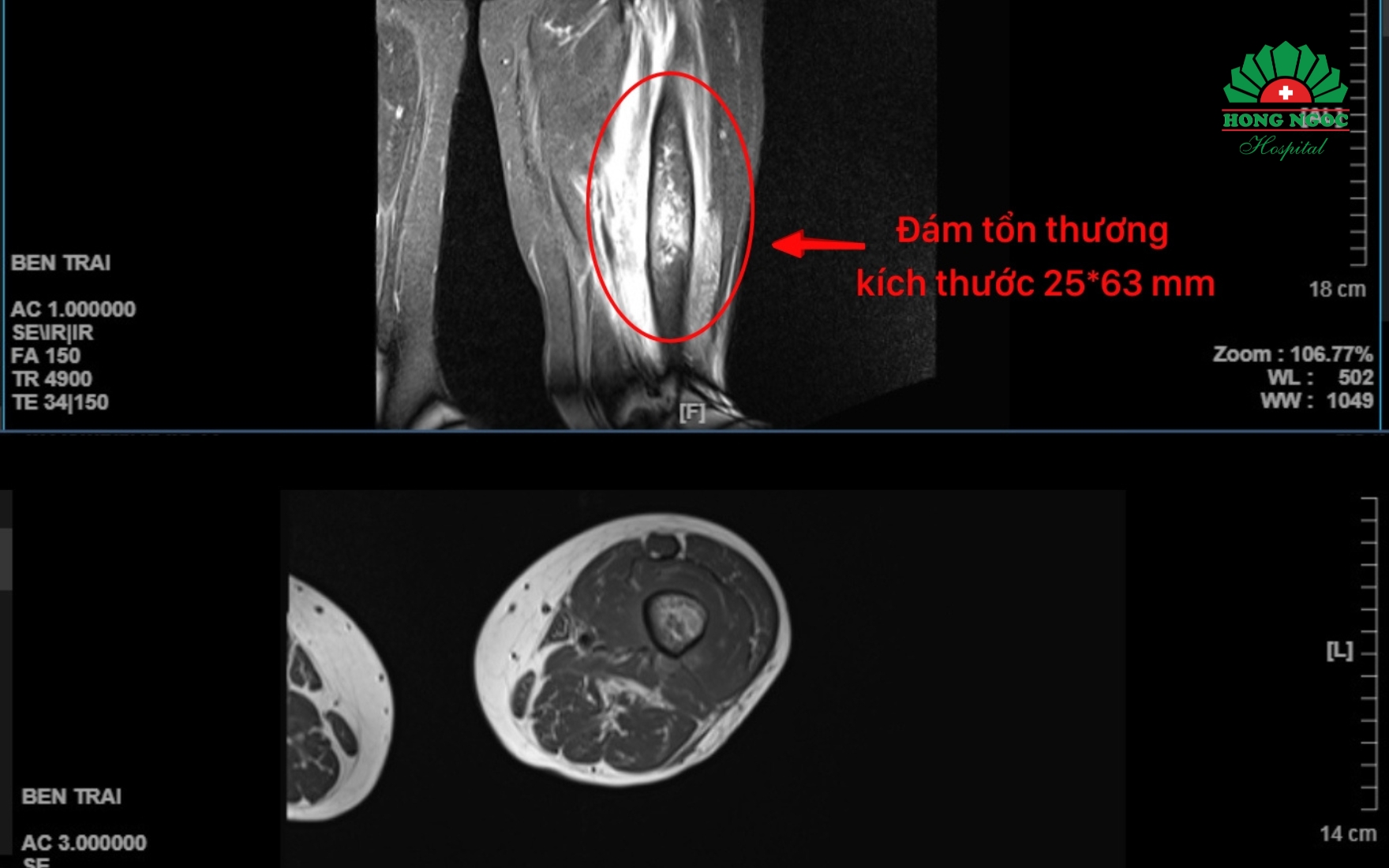 Ảnh chụp MRI vùng đùi trái của bệnh nhân P.T. Hồng