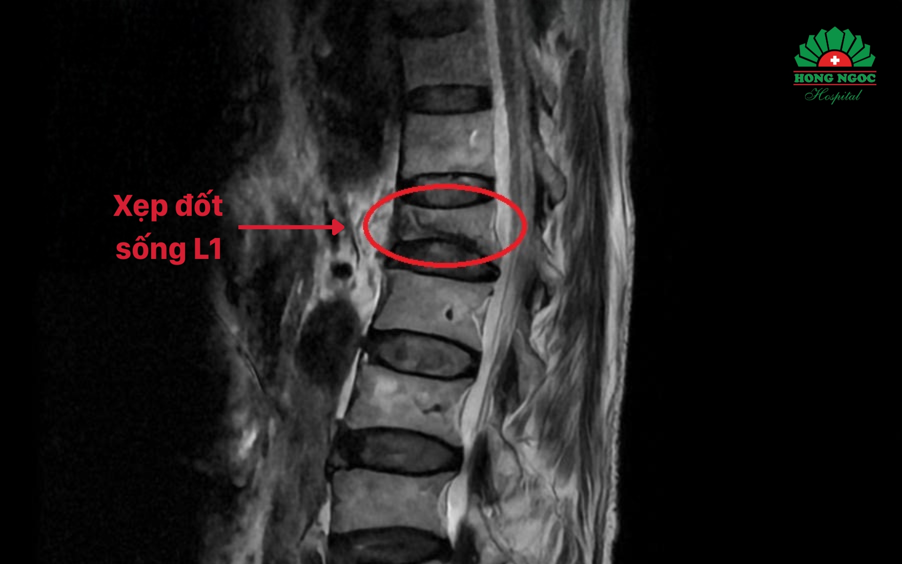 Kết quả chụp MRI phát hiện xẹp đốt sống L1
