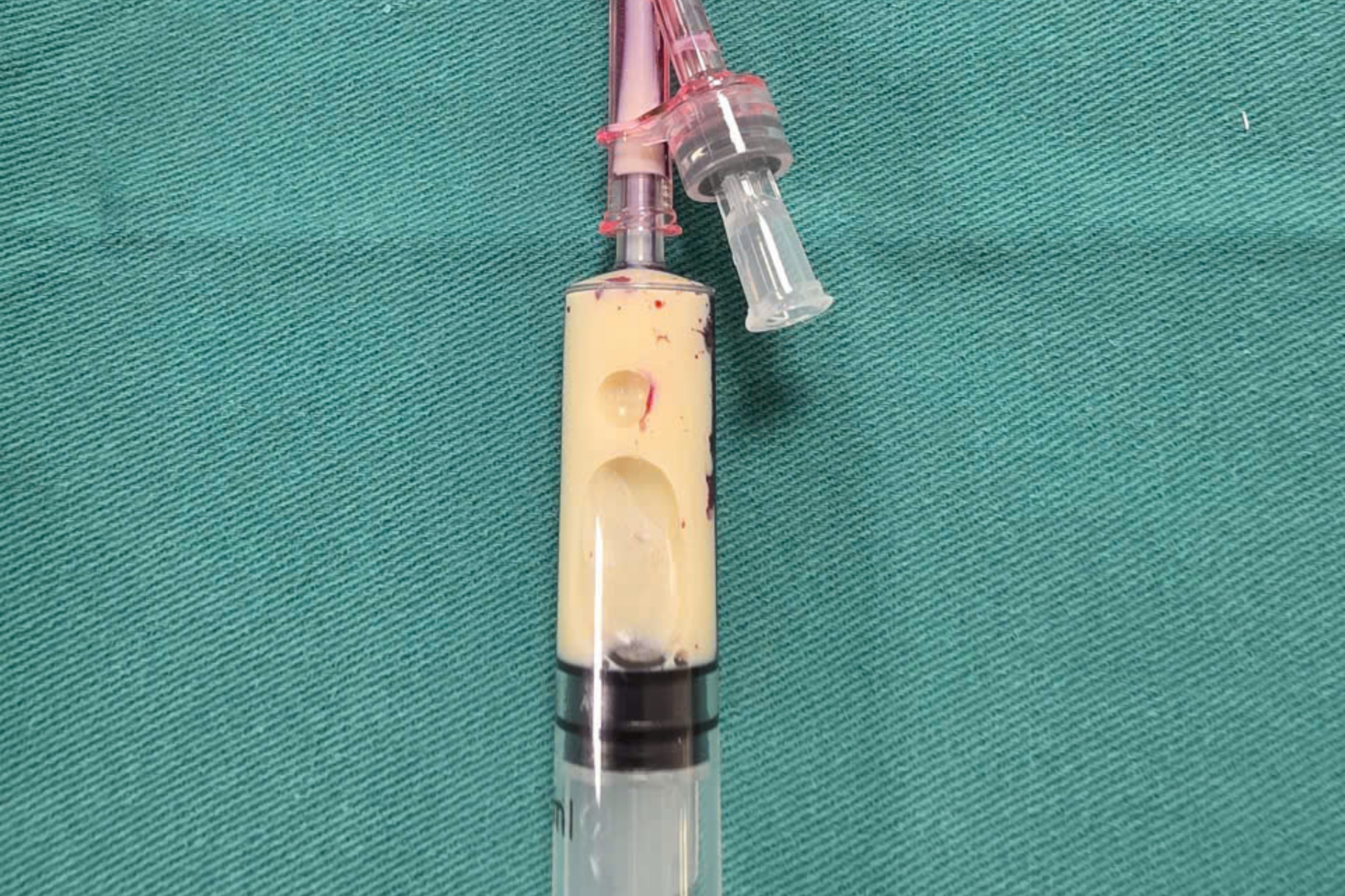 Mẫu huyết tương đục trắng