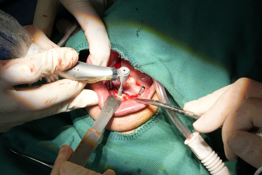 trồng răng implant tại Bệnh viện Hồng Ngọc