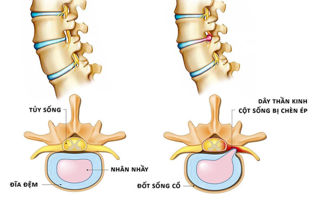 Tổn thương tủy sống