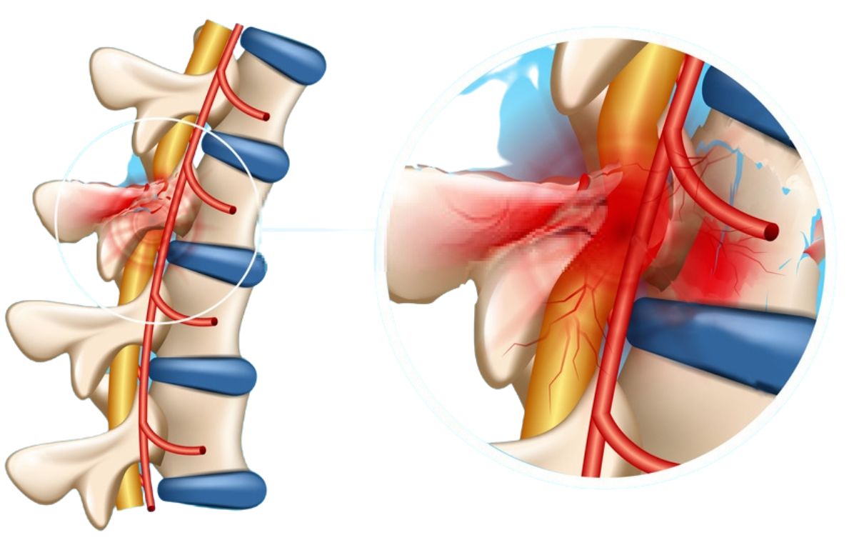 Tổn thương tủy sống