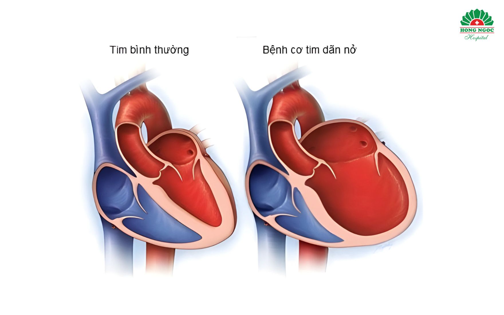 Benh Co Tim Gian (2)