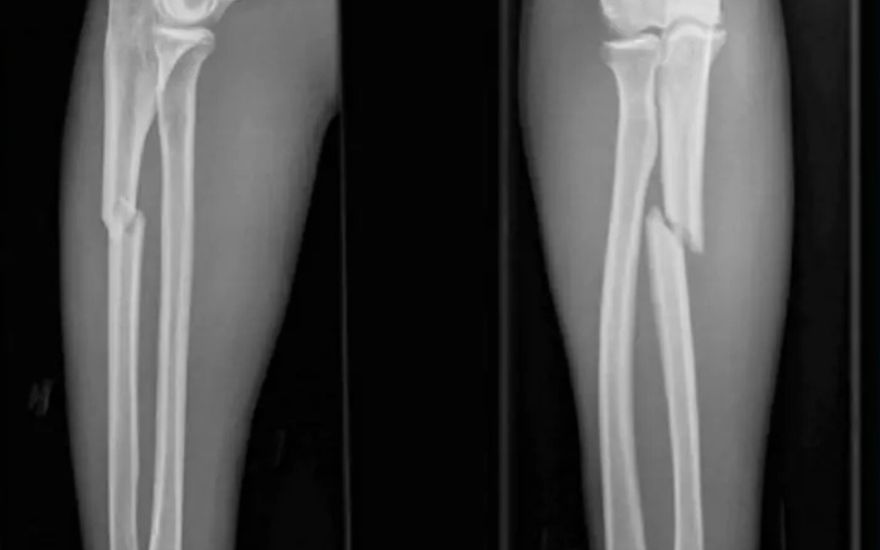 chậm liền xương