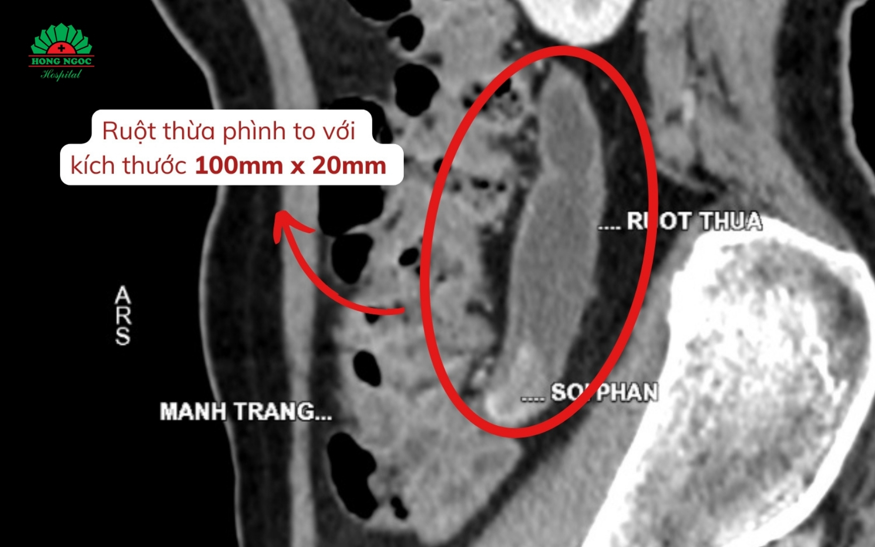 dieu-tri-thanh-cong-u-nhay-ruot-thua