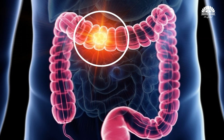 bieu-hien-cua-ung-thu-dai-trang