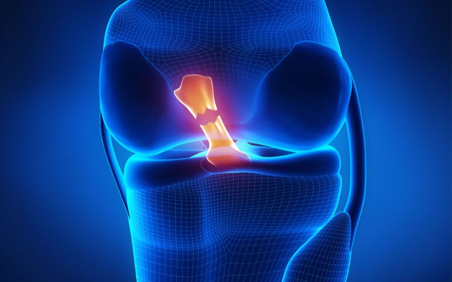 前交叉韧带断裂