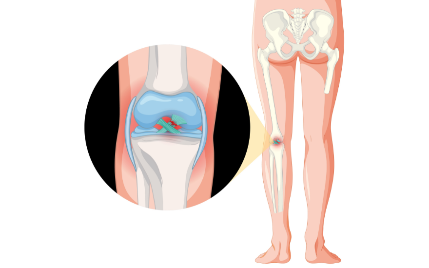 膝关节韧带断裂会直接影响膝关节的运动功能。
