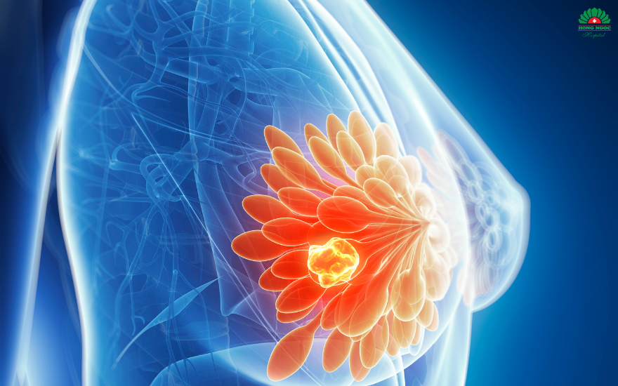 Breast fibroadenomas are tumors that develop within the breast tissue.
