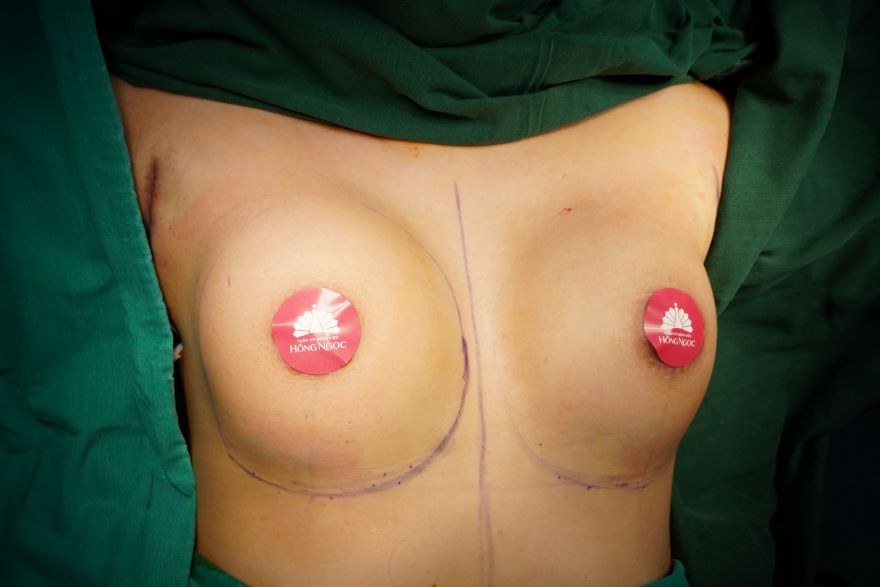 phẫu thuật nâng ngực đường nách
