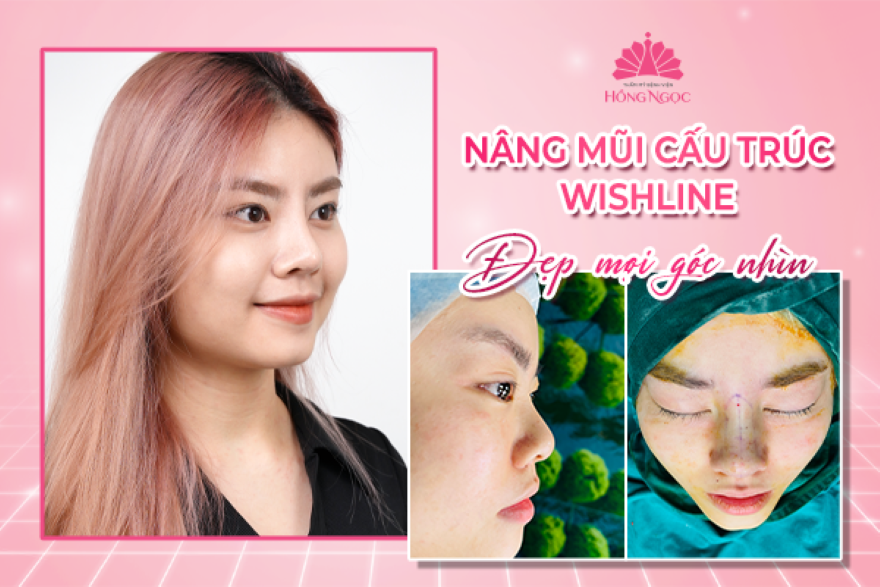 phẫu thuật nâng mũi cấu trúc