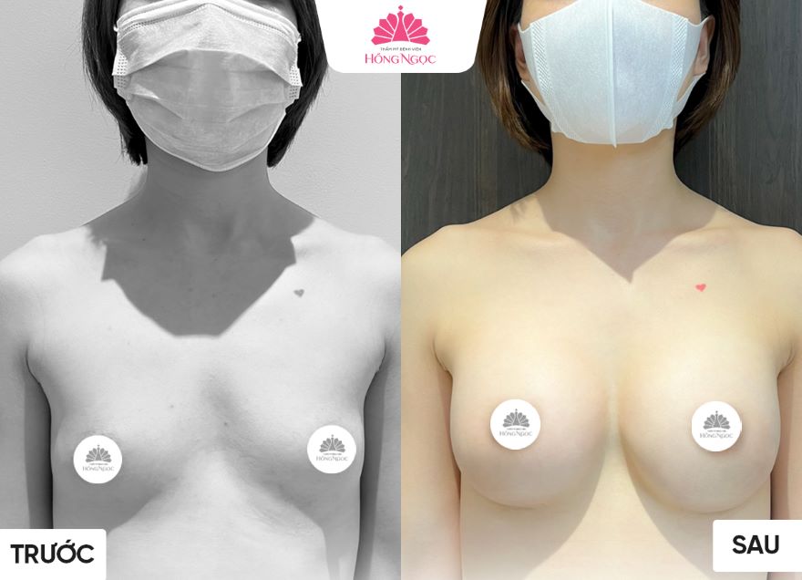 nâng ngực tại Thẩm Mỹ Bệnh Viện Hồng Ngọc