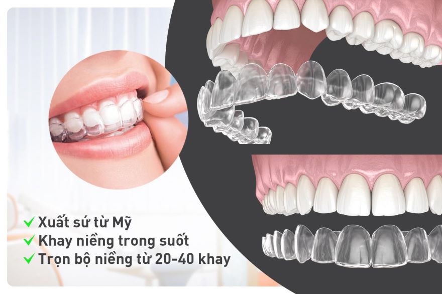 niềng răng invisalign