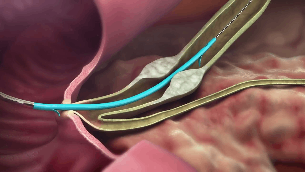 Noi Soi Mat Tuy Nguoc Dong Ercp 4