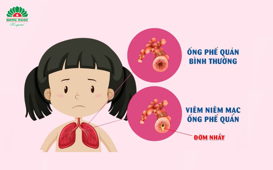 viêm phế quản ở trẻ em