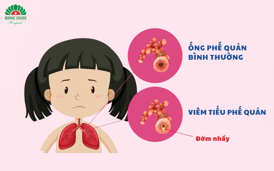 viêm tiểu phế quản ở trẻ