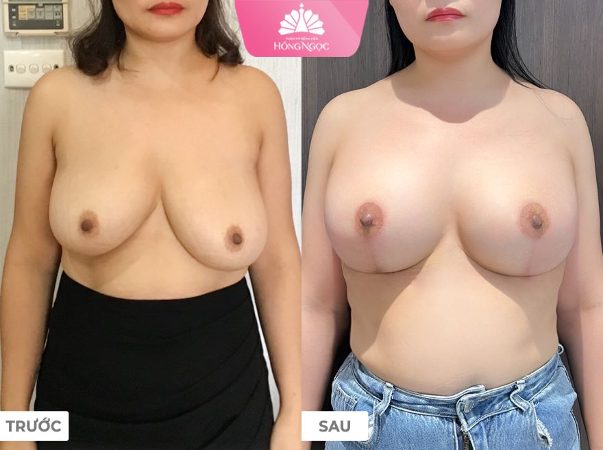 nâng ngực sa trễ