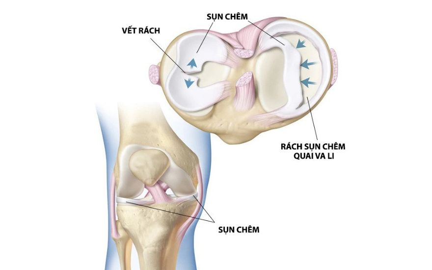 Rách sụn chêm khớp gối l