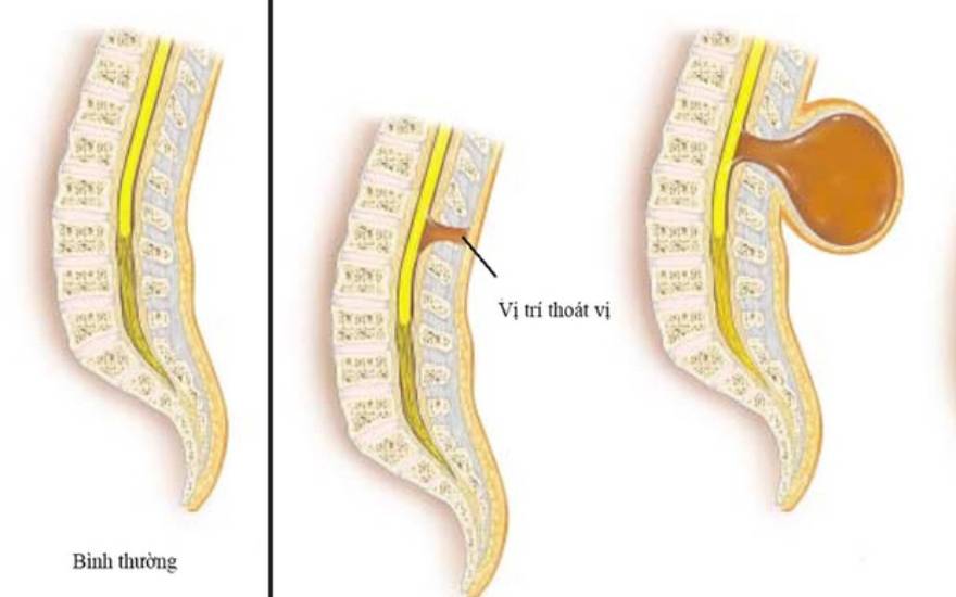 phẫu thuật thoát vị màng não tủy