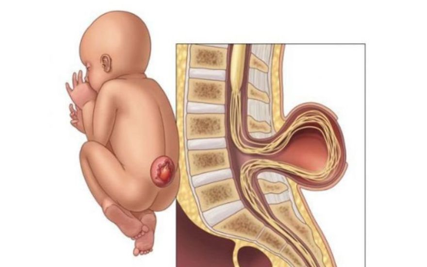phẫu thuật thoát vị màng não tủy