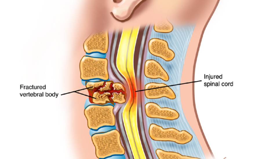 tổn thương tủy sống cổ