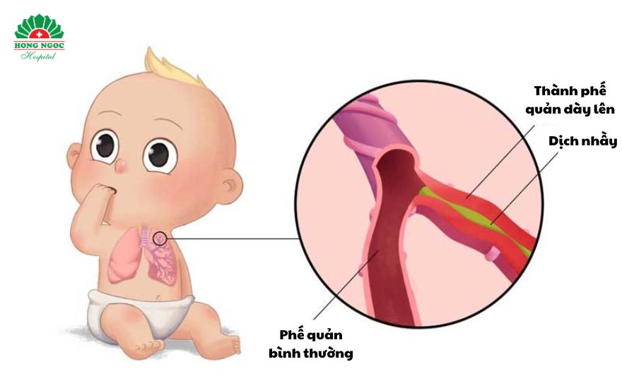 viêm phế quản ở trẻ sơ sinh
