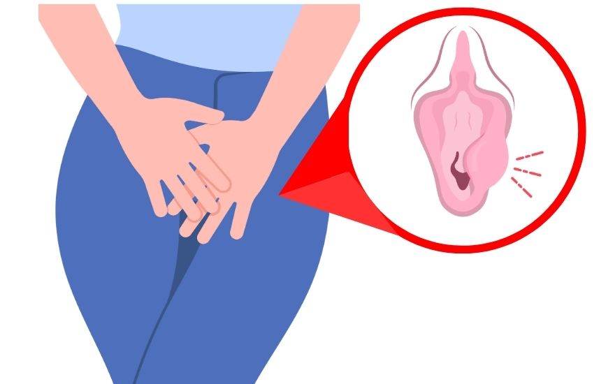 u nang tuyến bartholin