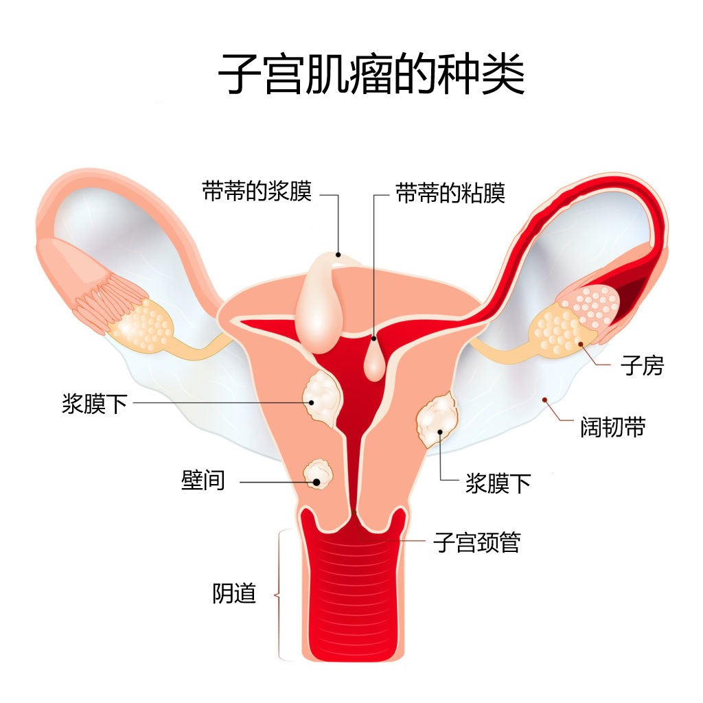 子宫肌瘤