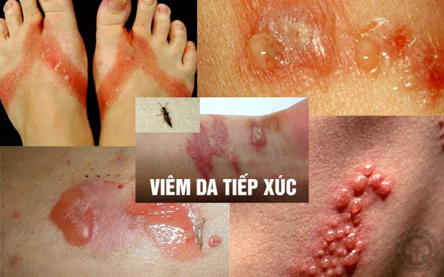 viêm da tiếp xúc