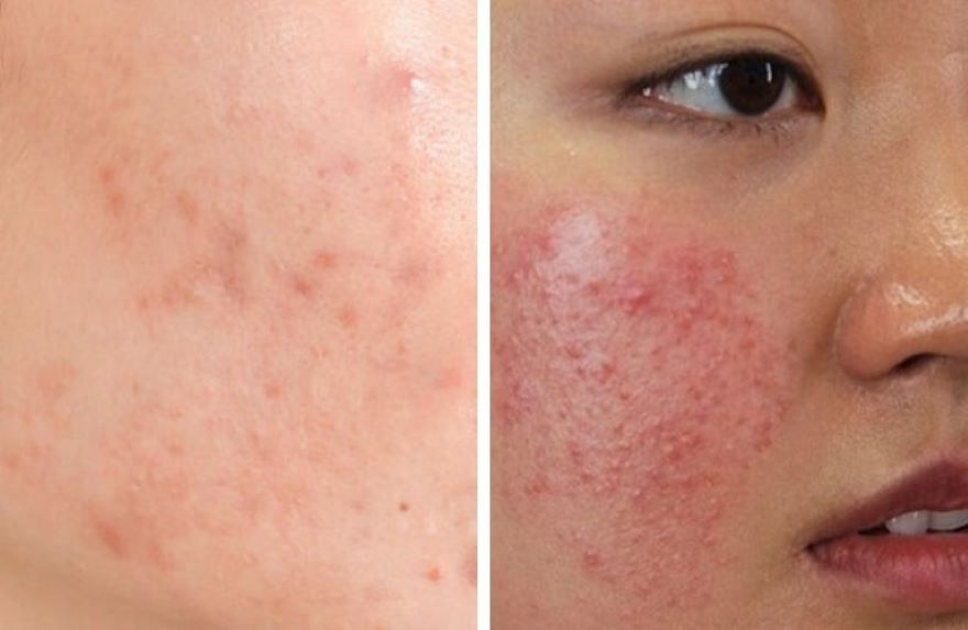 viêm da tiếp xúc dị ứng