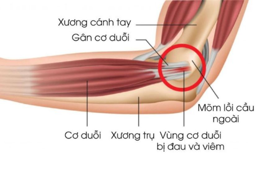 Viêm điểm bám gân lồi cầu ngoài khuỷu tay