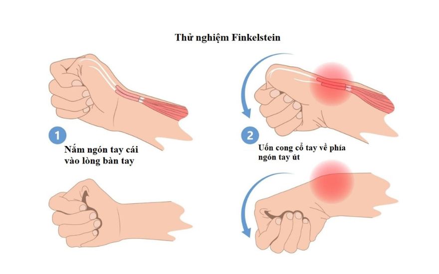 viêm gân vùng mỏm trâm quay cổ tay