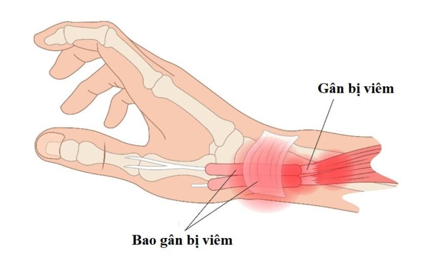 viêm gân vùng mỏm trâm quay cổ tay