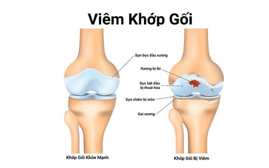 Viêm khớp gối