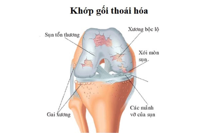 Viêm khớp gối