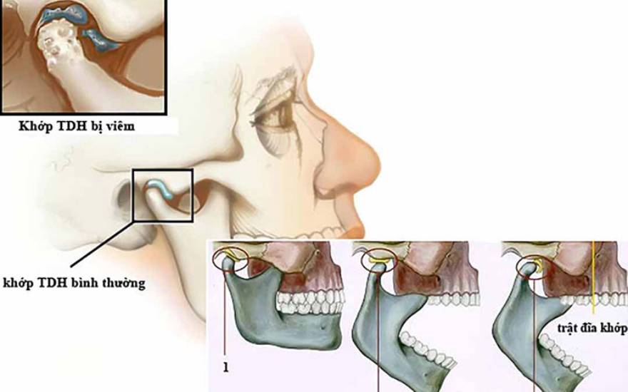 viêm khớp thái dương hàm