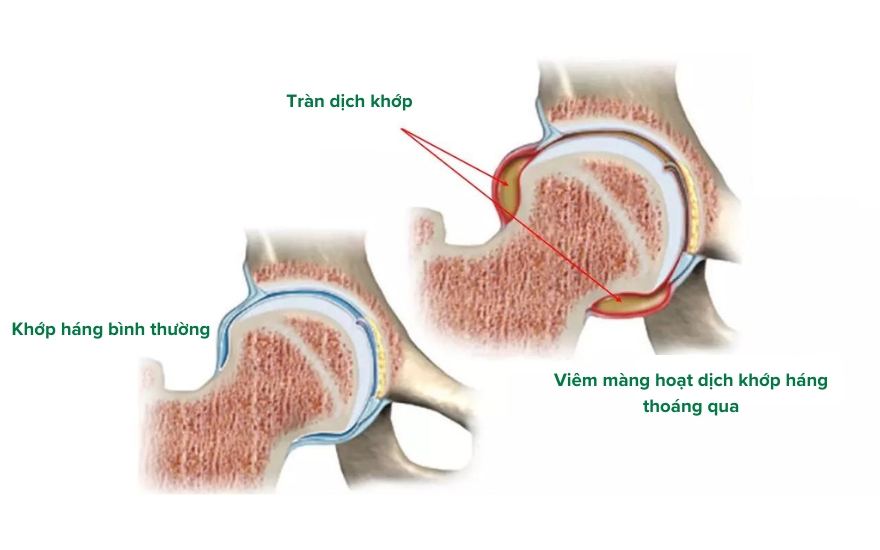 viêm màng hoạt dịch khớp háng thoáng qua