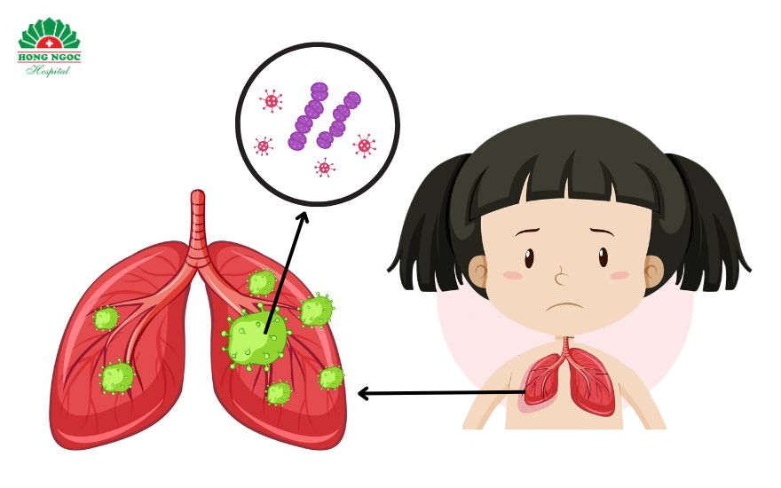 viêm phổi ở trẻ em