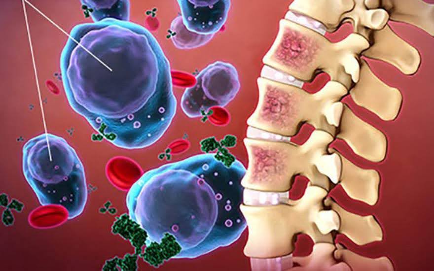 Viêm xương tủy xương