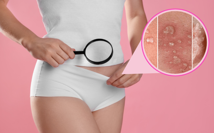 mọc mụn ở vùng kín