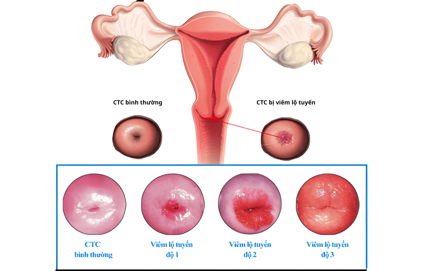 vùng kín ngứa và có dịch trắng